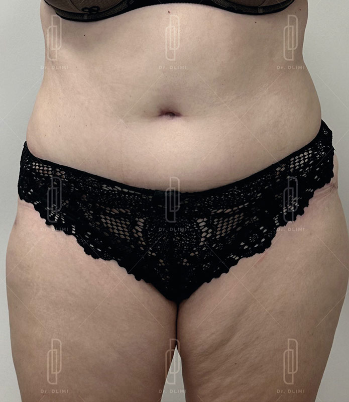 Apr&egrave;s abdominoplastie
