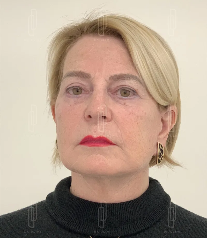 Apr&egrave;s lifting