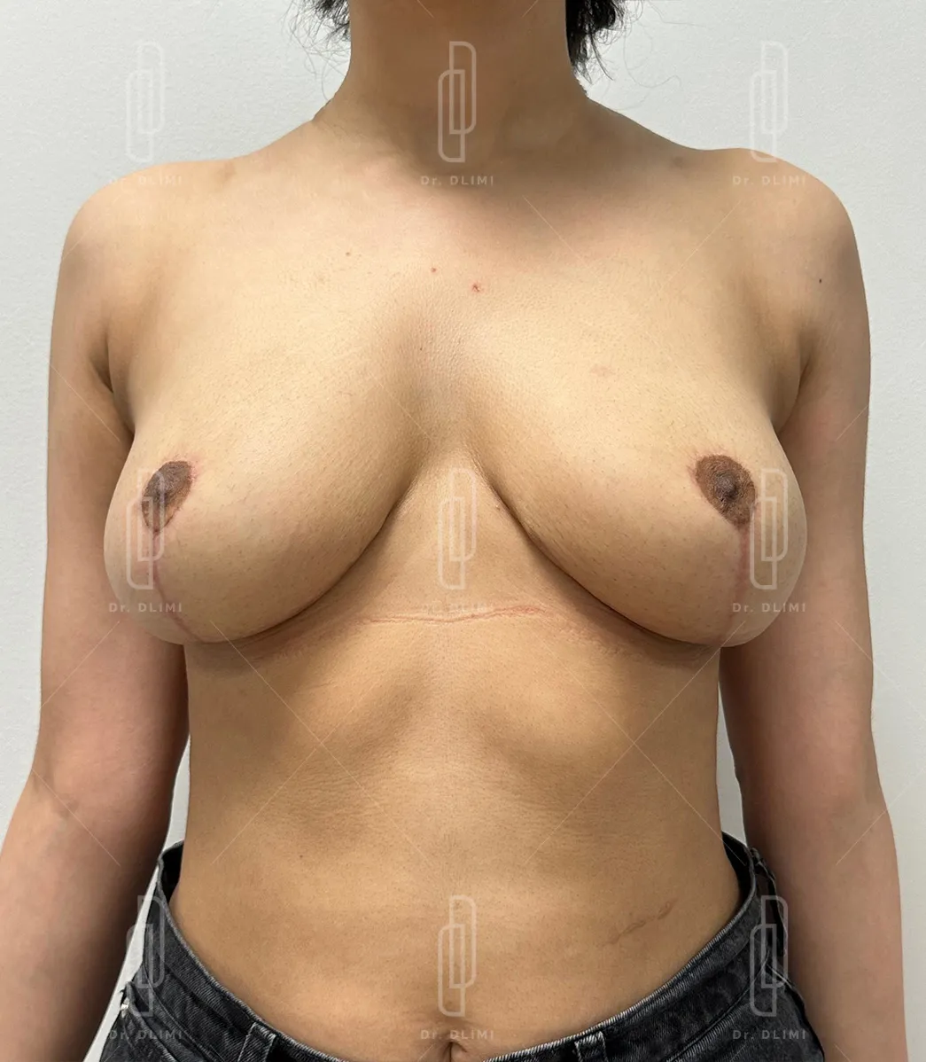 patiente apr&egrave;s l'intervention de r&eacute;duction mammaire