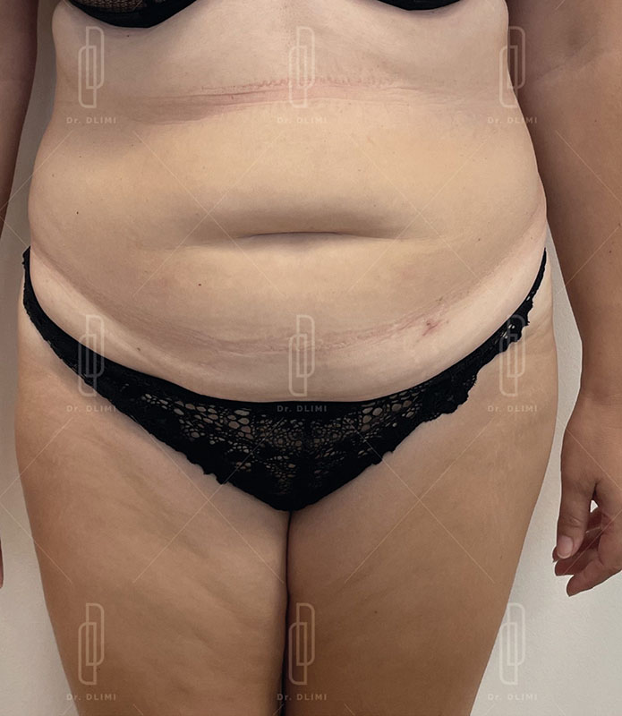 Avant abdominoplastie