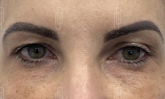 bl&eacute;pharoplastie avant intervention