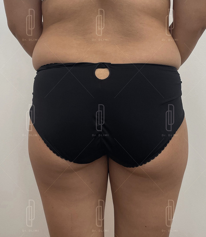 Avant Proth&egrave;ses de fesses