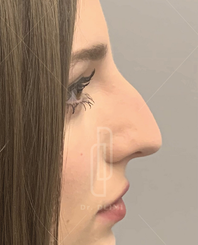 Avant rhinoplastie
