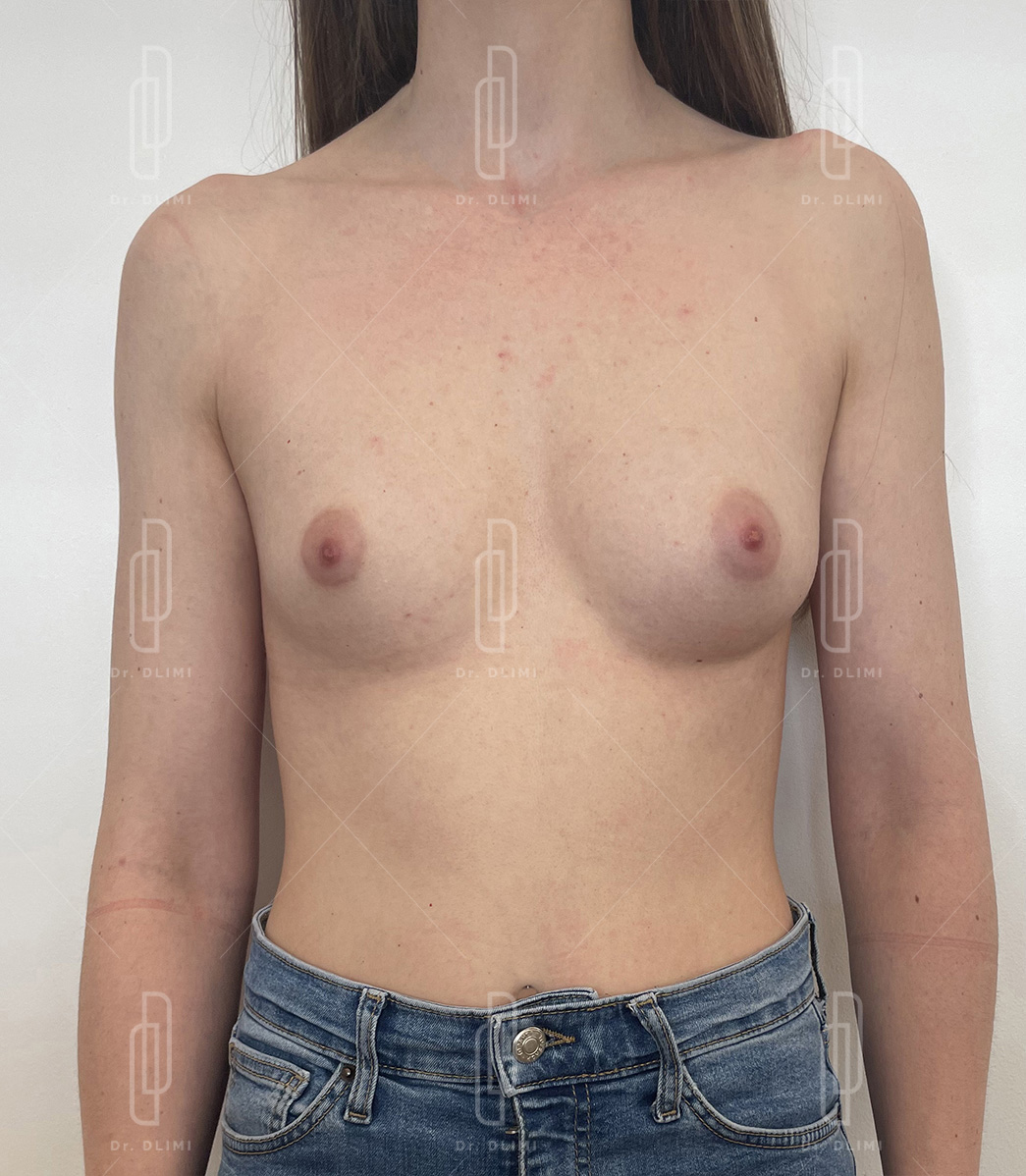 Avant augmentation mammaire